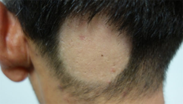 Pelada na cabeça característica da alopécia areata