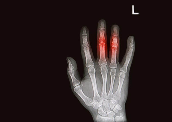 Radiografia de dedos com artrite