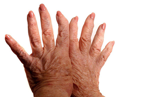 Mãos de mulher com artrite psoriática