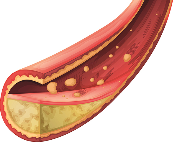 Artéria obstruída a ilustrar a aterosclerose