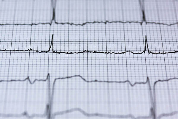 Electrocardiograma a ilustrar os fatores de risco da doença coronária