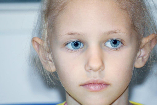 Menina de olhos azuis com falta de cabelo devido a quimioterapia