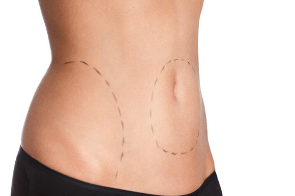 Barriga com marcas para lipoaspiração