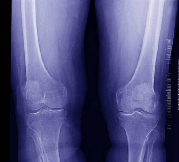 Radiografia aos joelhos