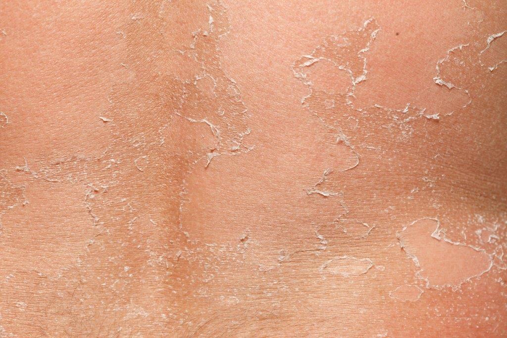 Epiderme