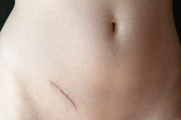 Cicatriz derivada da remoção do apêndice