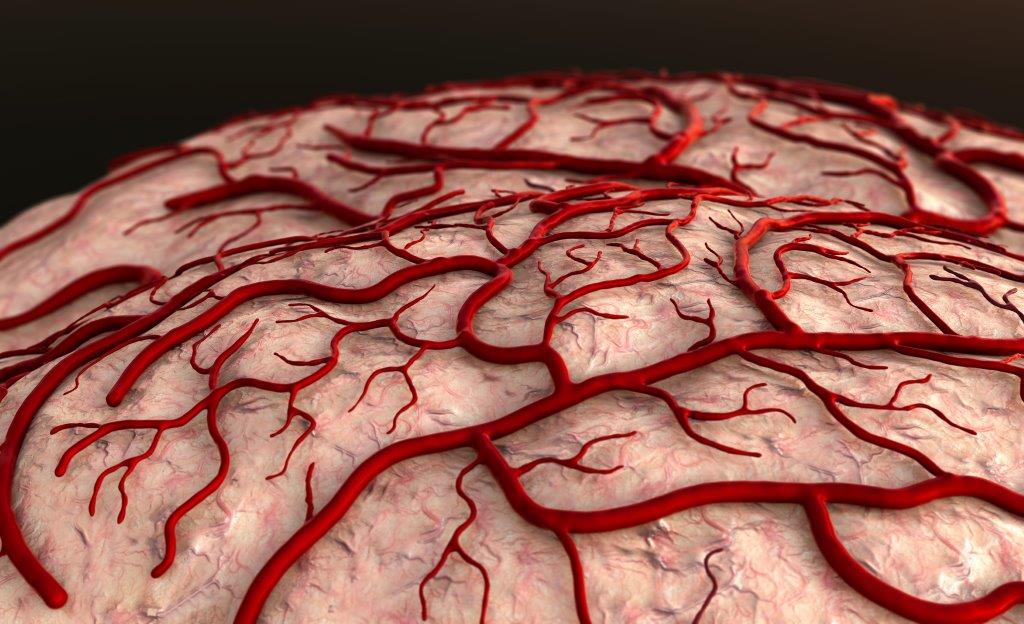 Acidente Vascular Cerebral