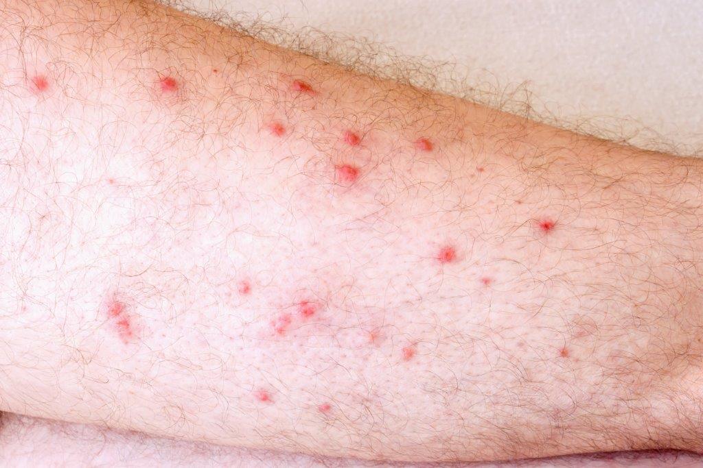 Anafilaxia Tema Da Semana Mundial Da Alergia Atlas Da Sa de