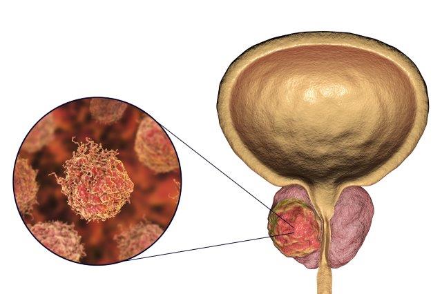 Adenom de prostata: cauze, simptome, complicatii, tratament | Bioclinica