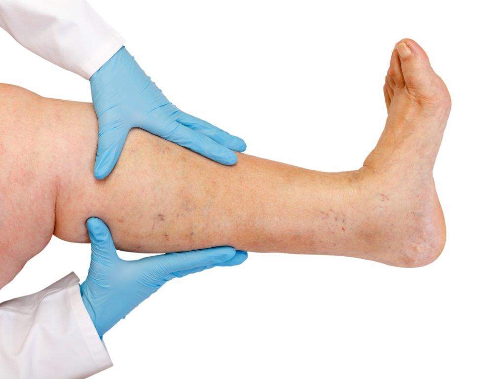Tempo de recuperação após cirurgia de ablação venosa