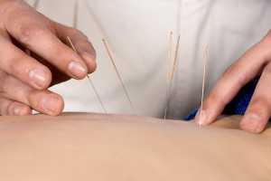 Terapeuta de acupunctura a aplicar agulhas