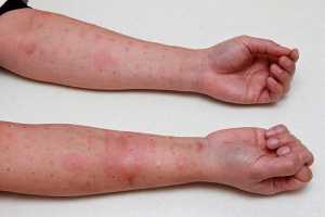 Braços com marcas após teste às alergias