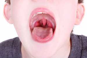 Rapaz de boca aberta a verem-se as amigdalas