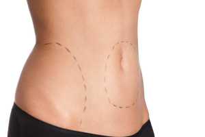 Barriga com marcas para lipoaspiração