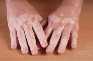 Mãos com vitiligo