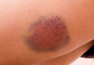 Hematoma