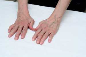 Mãos com artrite reumatoide