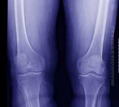 Radiografia aos joelhos