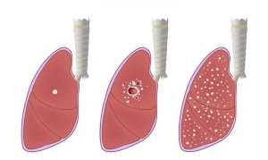 Evolução da tuberculose no pulmão