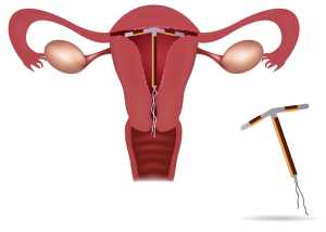 Dispositivo intra-uterino
