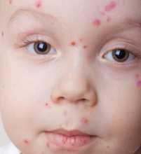 Criança com borbulhas na cara características da varicela