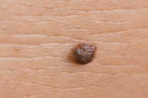papilloma skin pathology din ce negi genitale apar la femei