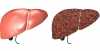 Fígado saudável e fígado com cirrose