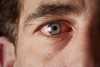 Homem com olho inflamado