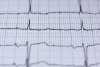 Electrocardiograma a ilustrar os fatores de risco da doença coronária