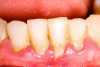 Gengivas inflamadas e com periodontite