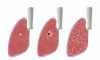 Evolução da tuberculose no pulmão