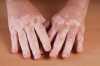 Mãos com vitiligo